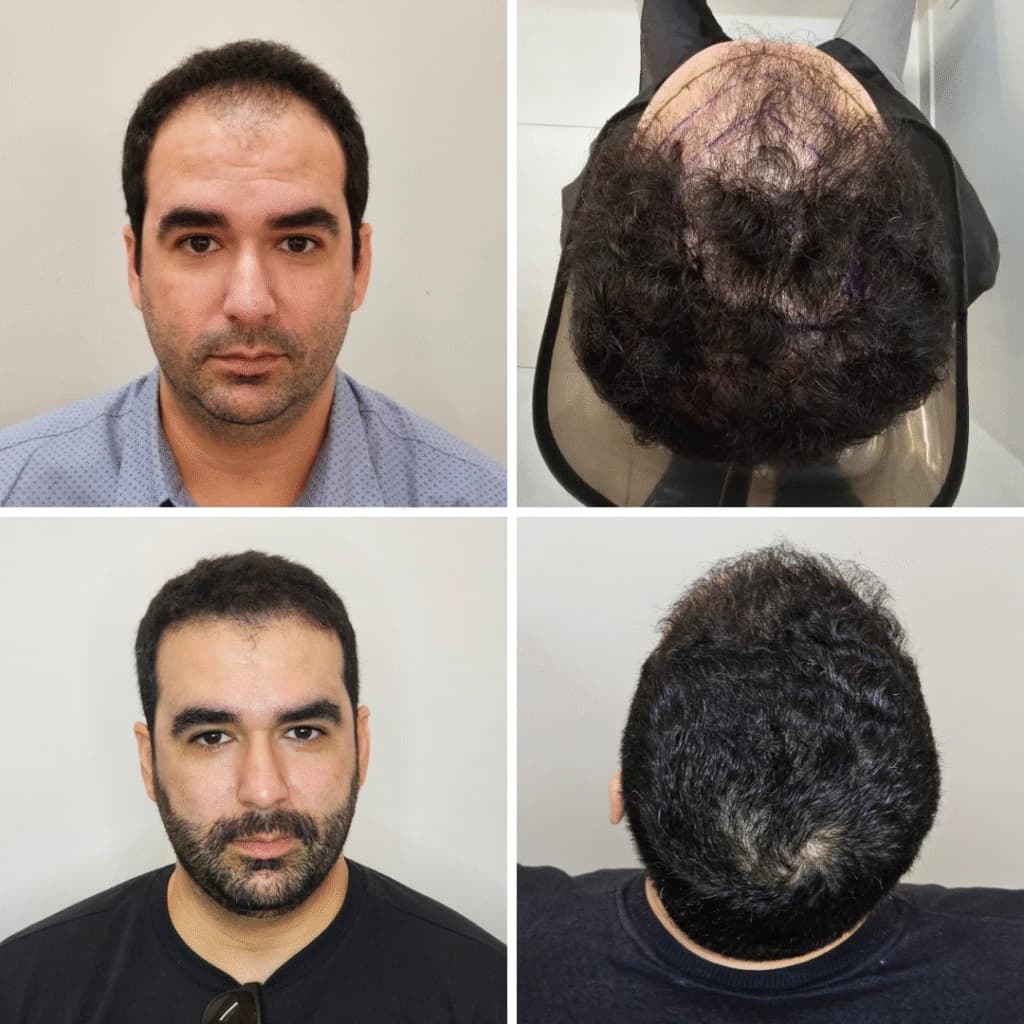 Caso clínico de transplante capilar 1