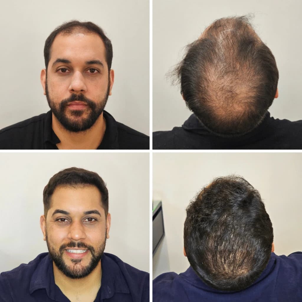 Caso clínico de transplante capilar 5