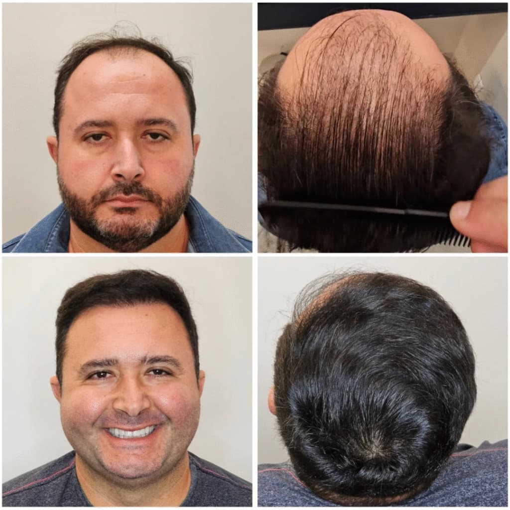 Caso clínico de transplante capilar 6